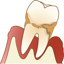 歯周病とは