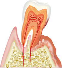 歯周病の原因