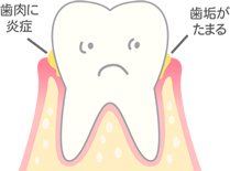 [進行度1] 歯ぐきがはれ、出血する