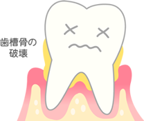 [進行度3] 歯がぐらついてくる